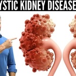 Polycystic Kidney Disease Cure: What You Need to Know About the Latest Advances is being swapped online for free