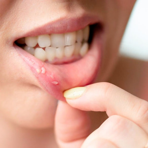 Natural Ways to Cure Oral Lichen Planus: Heal Your Smile Naturally is being swapped online for free