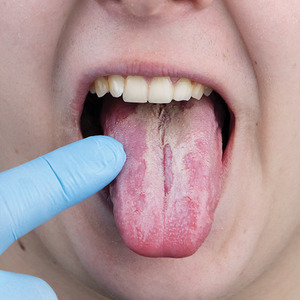 Oral Lichen Planus Treatment: Effective Home Remedies for Relief is being swapped online for free