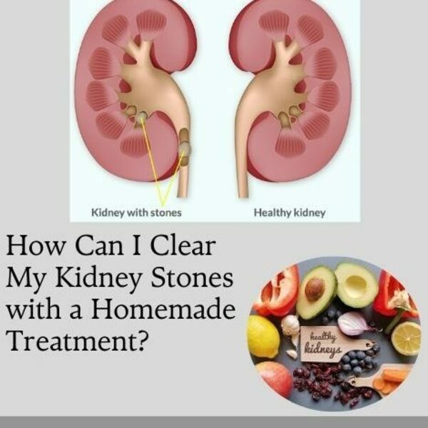 How Can I Clear My Kidney Stones with a Homemade Treatment? is being swapped online for free